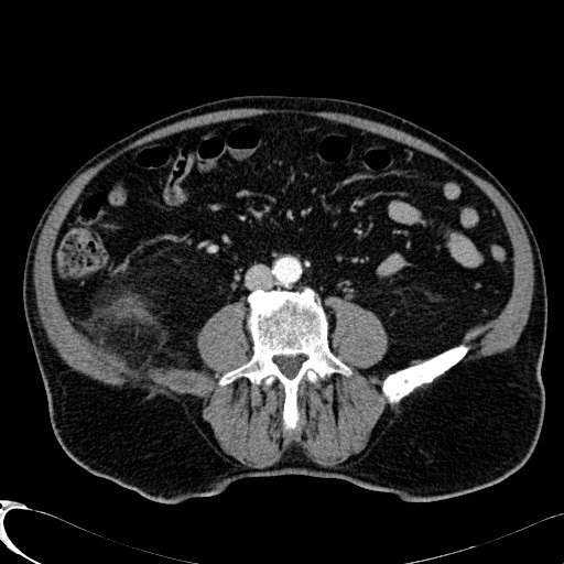 Appendiceal adenocarcinoma complicated by retroperitoneal abscess (Radiopaedia 58007-65039 B 80).jpg