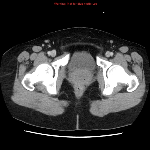 File:Appendiceal mucinous cystadenoma (Radiopaedia 8263-9111 Axial liver window 79).jpg