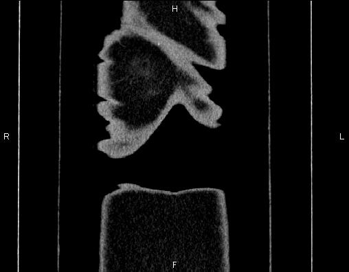 Appendiceal mucocele (Radiopaedia 83280-97688 B 81).jpg