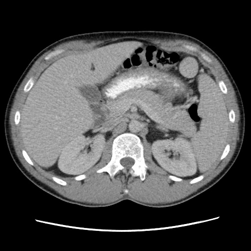 Appendicitis complicated by post-operative collection (Radiopaedia 35595-37114 A 28).jpg
