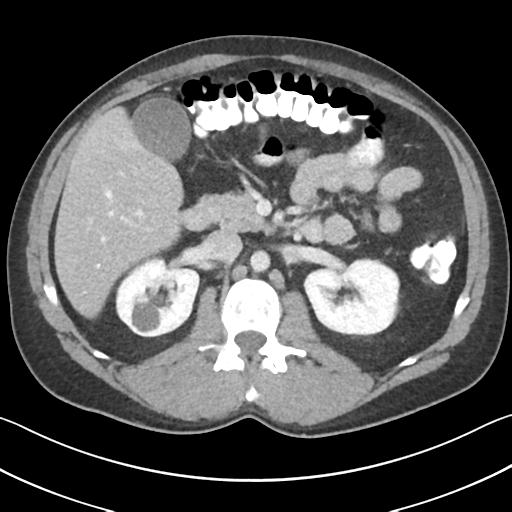 Appendicitis with cecal bar sign (Radiopaedia 31878-32830 B 31).jpg