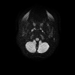 Arachnoid cyst - middle cranial fossa (Radiopaedia 67671-77088 Axial DWI 3).jpg