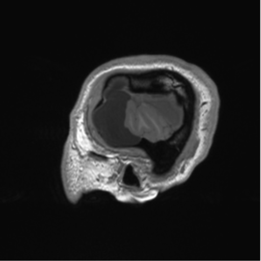 Arachnoid cyst with subdural hematoma (Radiopaedia 85892-101743 Sagittal T1 11).png