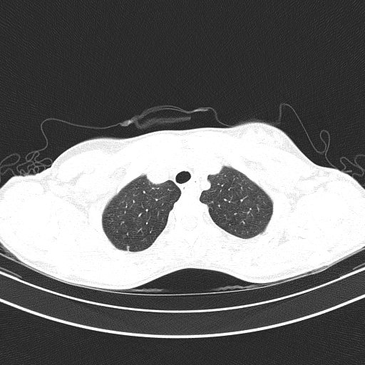 Arteria lusoria (Radiopaedia 88528-105192 Axial lung window 14).jpg