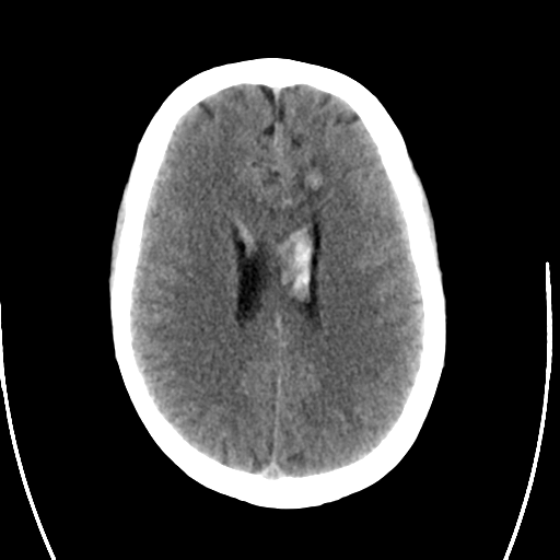 File:Arteriovenous malformation (cerebral) (Radiopaedia 40070-42579 Axial non-contrast 21).png