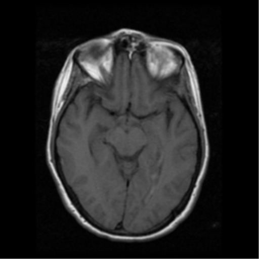 File:Arteriovenous malformation (cerebral) (Radiopaedia 40070-42580 Axial T1 9).png