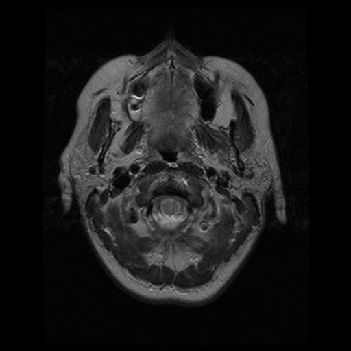 File:Arteriovenous malformation (cerebral) (Radiopaedia 40070-42580 Axial T2 2).png