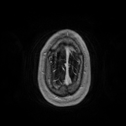 Artery of Percheron infarction (Radiopaedia 27975-28230 Axial T1 C+ fat sat 94).jpg