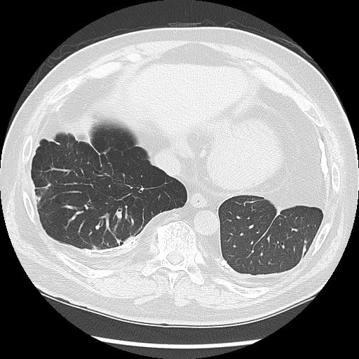 Asbestos-related pleural disease (Radiopaedia 74366-85250 Axial lung window 89).jpg