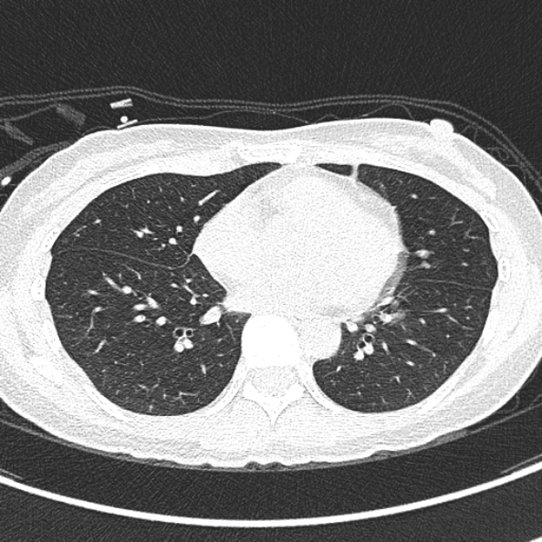 Aspergilloma (Radiopaedia 26223-26347 Axial lung window 47).jpg