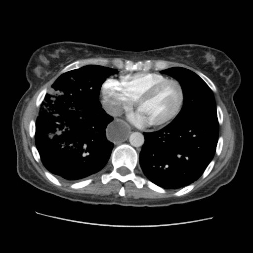 File:Aspiration pneumonia secondary to laparoscopic banding (Radiopaedia 18345-18183 A 36).jpg