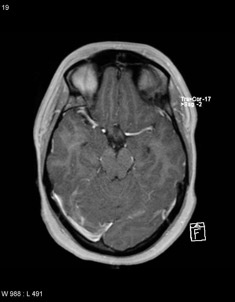 Astroblastoma (Radiopaedia 39792-42217 Axial T1 C+ 18).jpg
