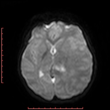 Astroblastoma (Radiopaedia 74287-85162 Axial DWI 51).jpg