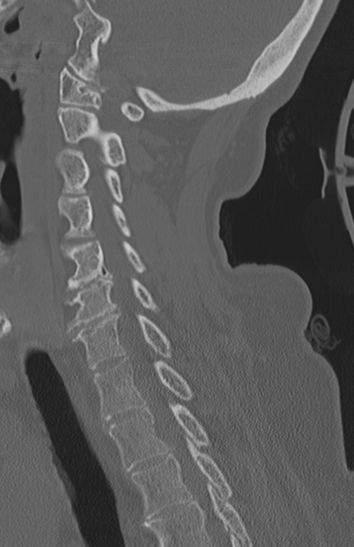 Atlanto-axial subluxation (Radiopaedia 36610-38176 Sagittal bone window 48).png