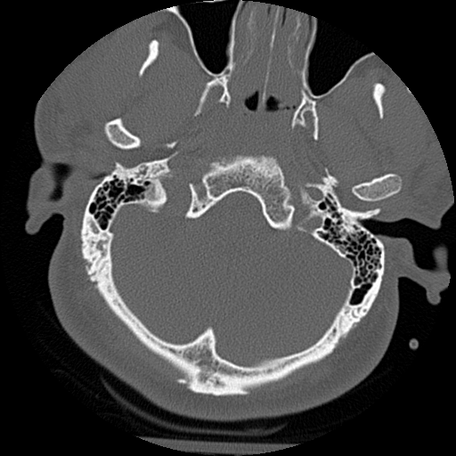 Atlanto-occipital dissociation injury (Radiopaedia 29274-29698 Axial bone window 2).png