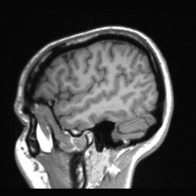 Atretic encephalocoele with inferior vermis hypoplasia (Radiopaedia 30443-31108 Sagittal T1 111).jpg