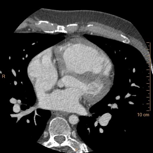 Atrial septal defect (upper sinus venosus type) with partial anomalous pulmonary venous return into superior vena cava (Radiopaedia 73228-83961 A 125).jpg
