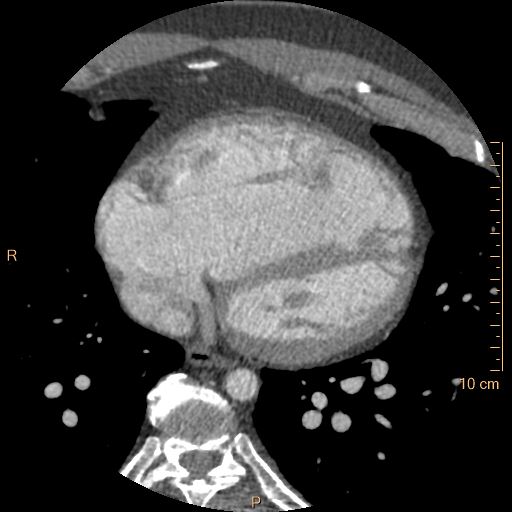 File:Atrial septal defect (upper sinus venosus type) with partial anomalous pulmonary venous return into superior vena cava (Radiopaedia 73228-83961 A 191).jpg