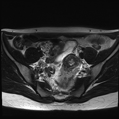 File:Atypical deep infiltrating endometriosis (Radiopaedia 44470-48125 Axial T2 8).jpg