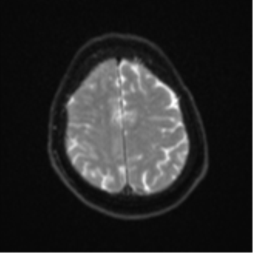Atypical meningioma (WHO Grade II) (Radiopaedia 54742-60979 Axial DWI 22).png