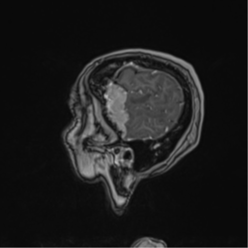Atypical meningioma (WHO Grade II) (Radiopaedia 54742-60979 Sagittal T1 C+ 65).png