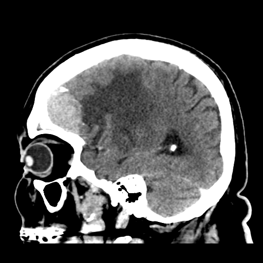 Atypical meningioma (WHO grade II) with brain invasion (Radiopaedia 57767-64728 Sagittal C+ 15).png