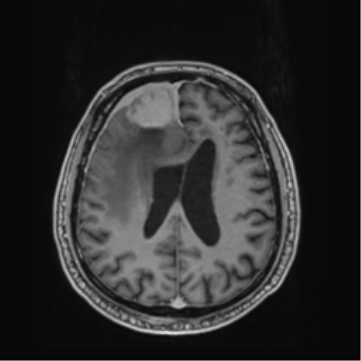 File:Atypical meningioma (WHO grade II) with brain invasion (Radiopaedia 57767-64729 Axial T1 C+ 32).png