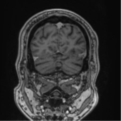 Atypical meningioma (WHO grade II) with brain invasion (Radiopaedia 57767-64729 Coronal T1 C+ 72).png
