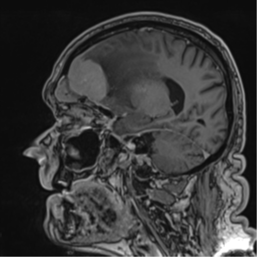 Atypical meningioma (WHO grade II) with brain invasion (Radiopaedia 57767-64729 Sagittal T1 C+ 43).png