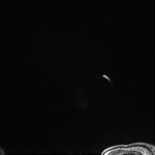 Atypical meningioma (WHO grade II) with brain invasion (Radiopaedia 57767-64729 Sagittal T1 C+ 68).png