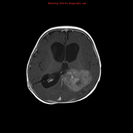 File:Atypical teratoid rhabdoid tumor (Radiopaedia 10712-11183 Axial T1 C+ 8).jpg