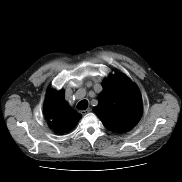 Autosomal dominant polycystic kidney disease (Radiopaedia 27851-28094 Axial non-contrast 10).jpg