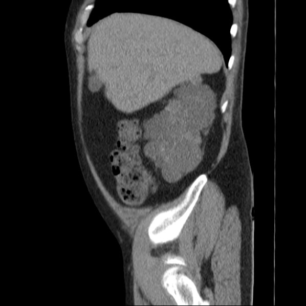 Autosomal dominant polycystic kidney disease (Radiopaedia 36539-38101 D 18).jpg