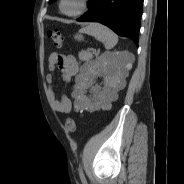 Autosomal dominant polycystic kidney disease (Radiopaedia 36539-38101 D 62).jpg