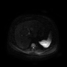 Autosomal dominant polycystic kidney disease (Radiopaedia 50259-55611 Axial DWI 83).jpg