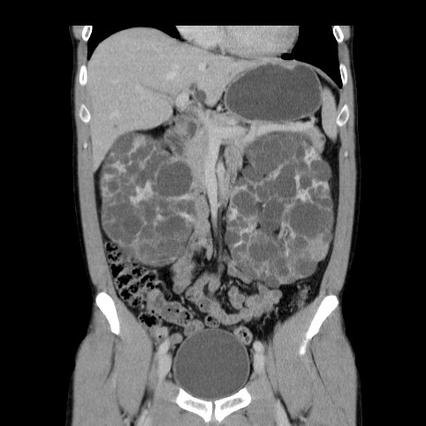 Autosomal dominant polycystic kidney disease (Radiopaedia 66349-75582 A 29).jpg