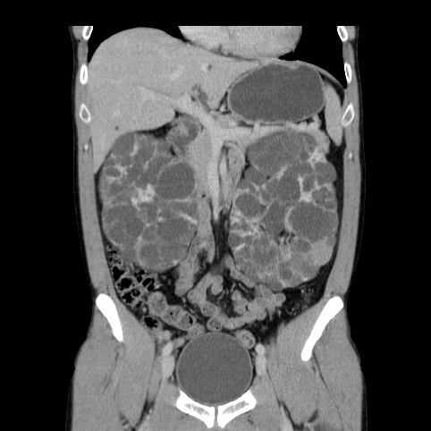Autosomal dominant polycystic kidney disease (Radiopaedia 66349-75582 A 30).jpg