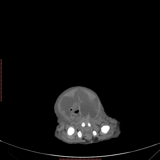 Autosomal recessive polycystic kidney disease associated with Caroli disease (Radiopaedia 61932-69984 Axial non-contrast 348).jpg