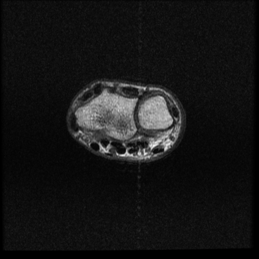 File:Avascular necrosis - scaphoid non-union (Radiopaedia 63457-72065 Axial T1 16).jpg