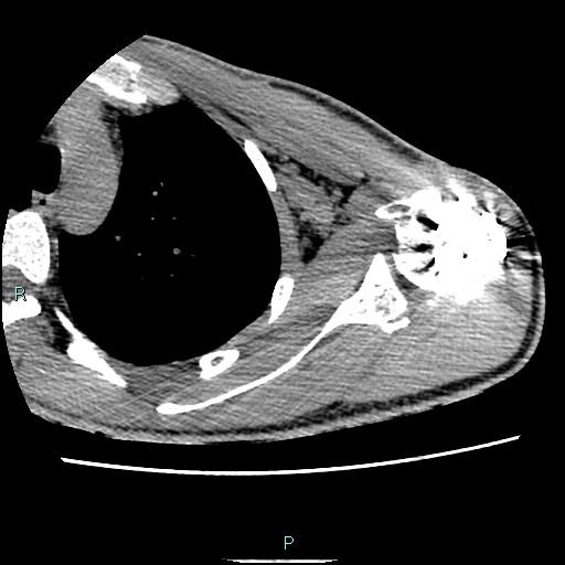 File:Avascular necrosis after fracture dislocations of the proximal humerus (Radiopaedia 88078-104653 D 44).jpg