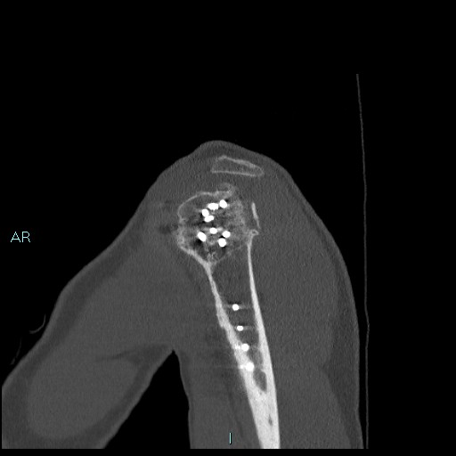 Avascular necrosis after fracture dislocations of the proximal humerus (Radiopaedia 88078-104655 Sagittal bone window 16).jpg