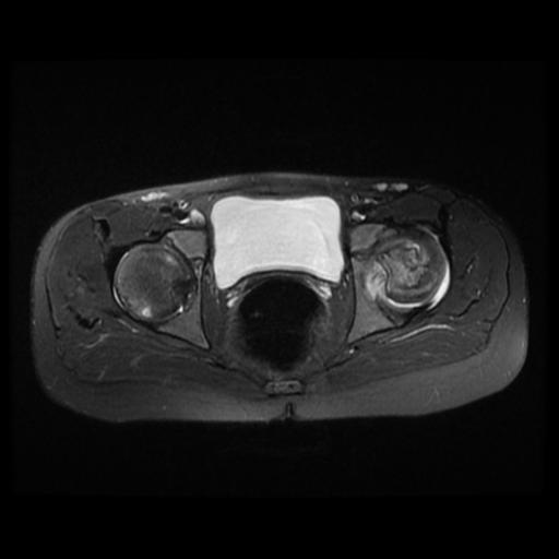 File:Avascular necrosis of the hip (Radiopaedia 29563-30067 Axial T2 fat sat 6).jpg