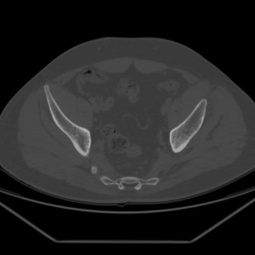 File:Avascular necrosis of the hip (Radiopaedia 61503-69467 Axial bone window 19).jpg