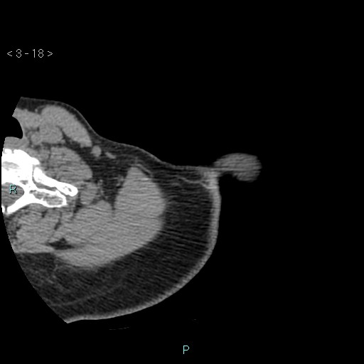 File:Avascular necrosis of the shoulder - Cruess stage I (Radiopaedia 77674-89887 Axial soft tissues 6).jpg