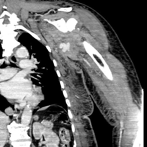 File:Axillary arterial pseudoaneurysm (Radiopaedia 24925-25195 B 10).jpg