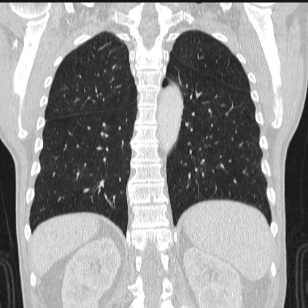Azygos lobe (Radiopaedia 38259-40275 Coronal lung window 58).jpg
