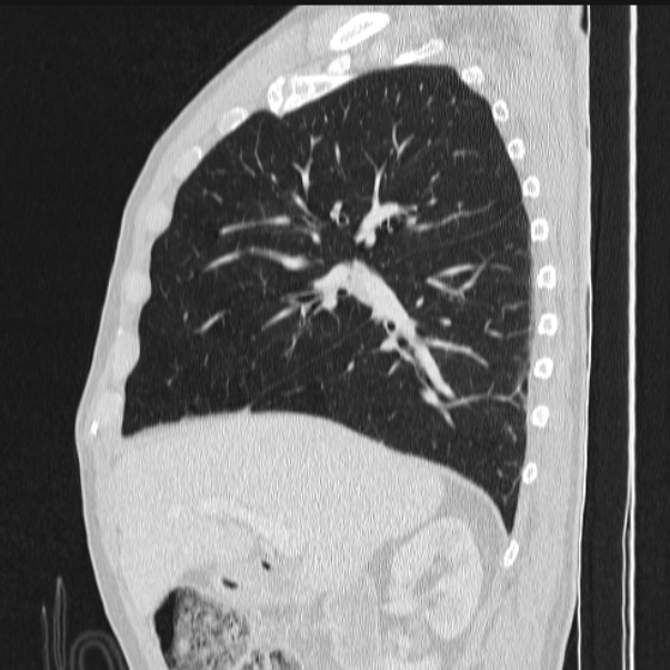 Azygos lobe (Radiopaedia 38259-40275 lung window 36).jpg