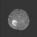 Balo concentric sclerosis (Radiopaedia 50458-55940 Axial DWI 53).jpg