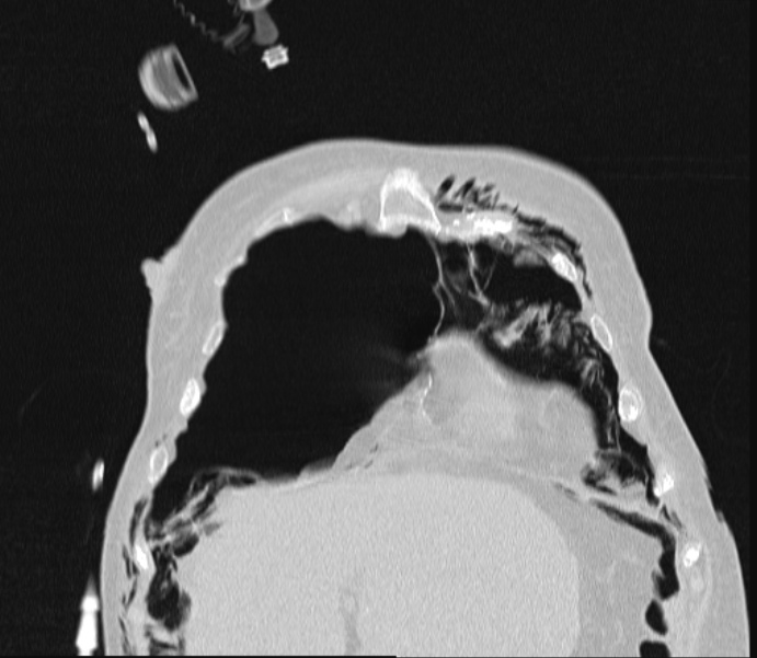 Barotrauma due to mechanical ventilation (Radiopaedia 28079-28336 Coronal lung window 21).jpg