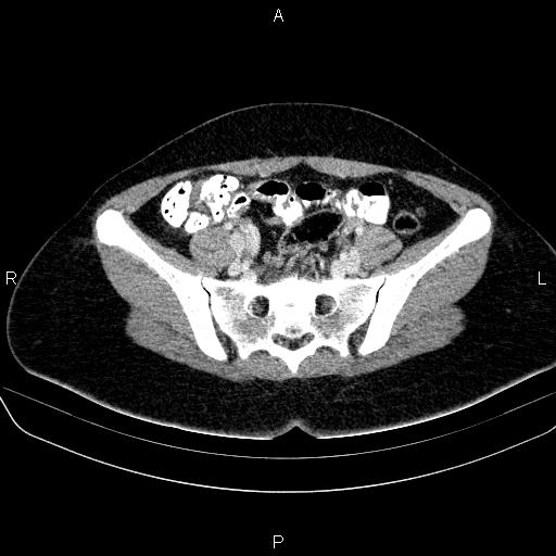 File:Bartholin gland cyst (Radiopaedia 62635-70930 Axial Post contrast 25).jpg